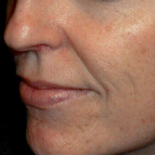 Skin tightening